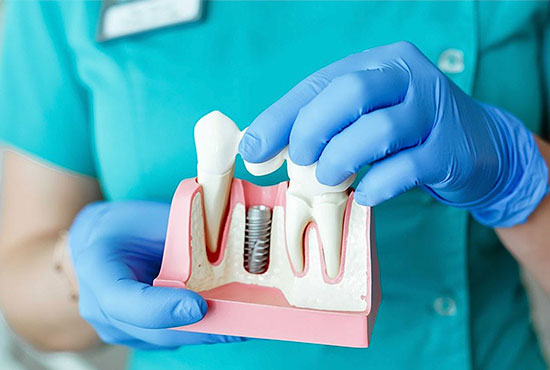Имплантация зубов с гарантией приживления